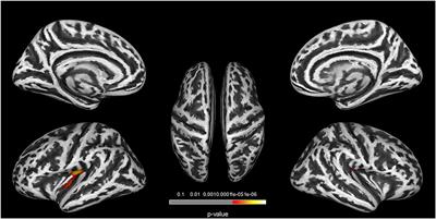 Altered local gyrification and functional connectivity in type 2 diabetes mellitus patients with mild cognitive impairment: A pilot cross-sectional small-scale single center study